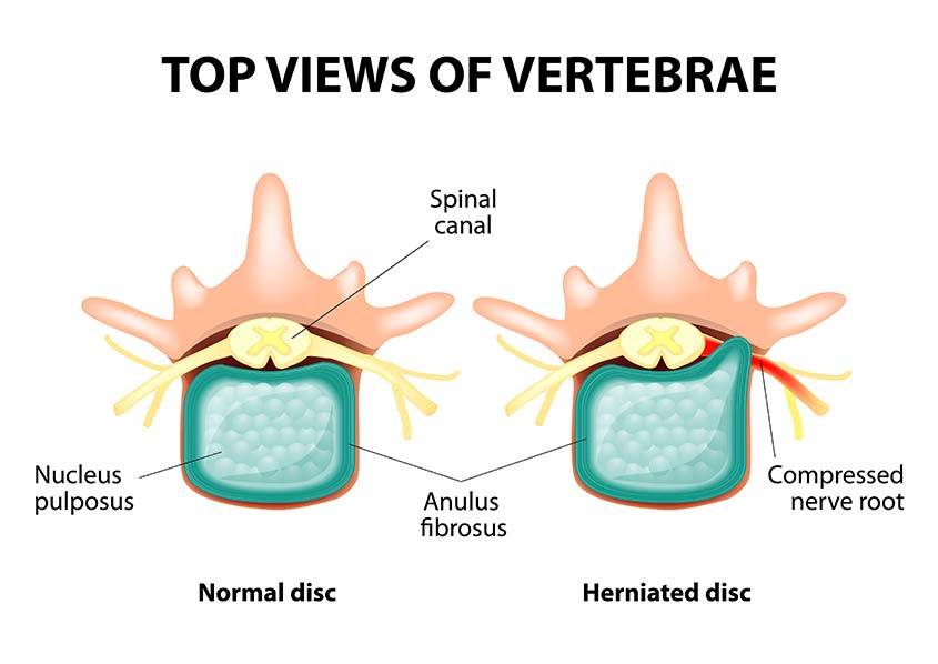 Slipped Disc | Elevate Chiropractic | Chiropractic & Wellness Clinic | SW Calgary